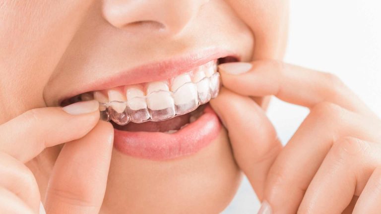 how much are invisalign in canada